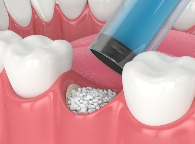 Bone Grafts Premier Smiles of Bellevue