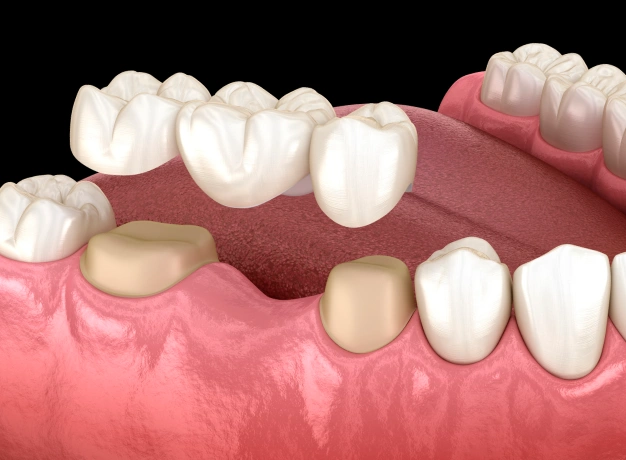 Tooth Extractions Premier Smiles of Bellevue