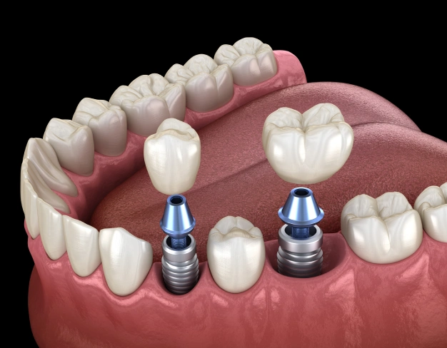 Dental Implants Premier Smiles of Bellevue
