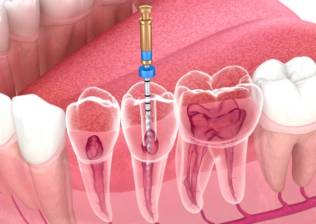 Dental Scaling and Root Planing at Premier Smiles of Bellevue